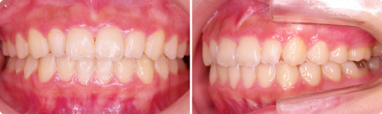 永久歯列矯正（2期治療）後（1年7ヶ月） 写真
