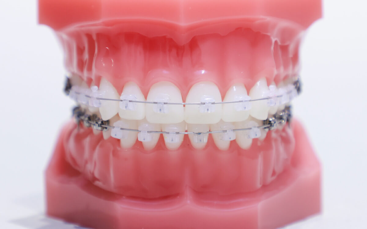 目立たない矯正装置｜ワダ矯正歯科｜国立市 国立駅
